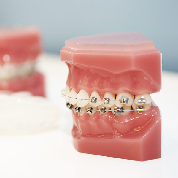 Behandlungsspektrum - Feste Zahnspange - Damon® Bracket System – für eine sanfte, effektive und komfortable Behandlung
